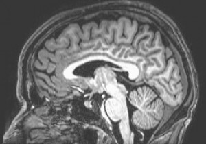תמונה של המוח האנושי המתקבלת לאחר סריקת MRI
