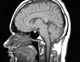 MRI_head_side