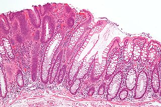 תצלום מיקרוסקופי של אדונומה, סוג של פוליפ במעי הגס המבשר את סרטן המעי הגס