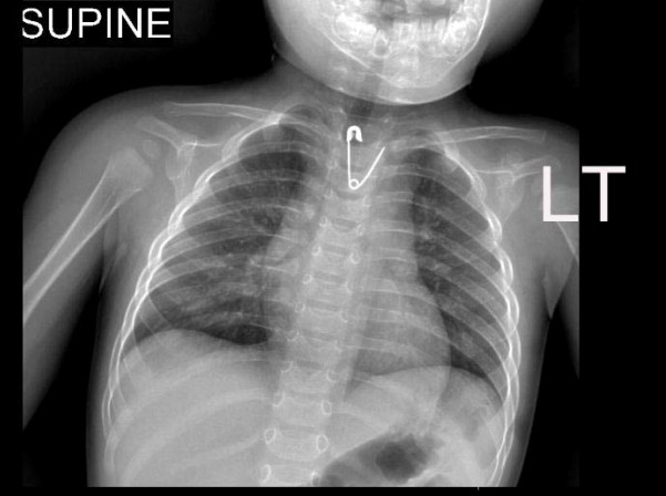 צילום רנטגן של ריאות הילד