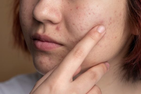 איך רואקוטן משפיע על העור?